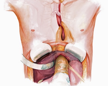 Corinne Sandone-esophagectomy detail Corinne Sandone-esophagectomy detail
