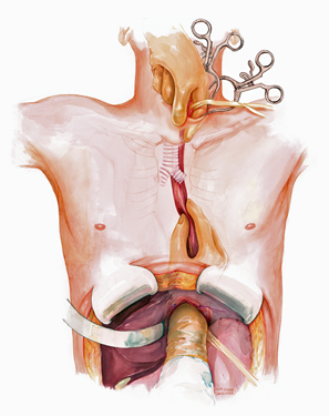 Sandone, Corinne Esophagectomy