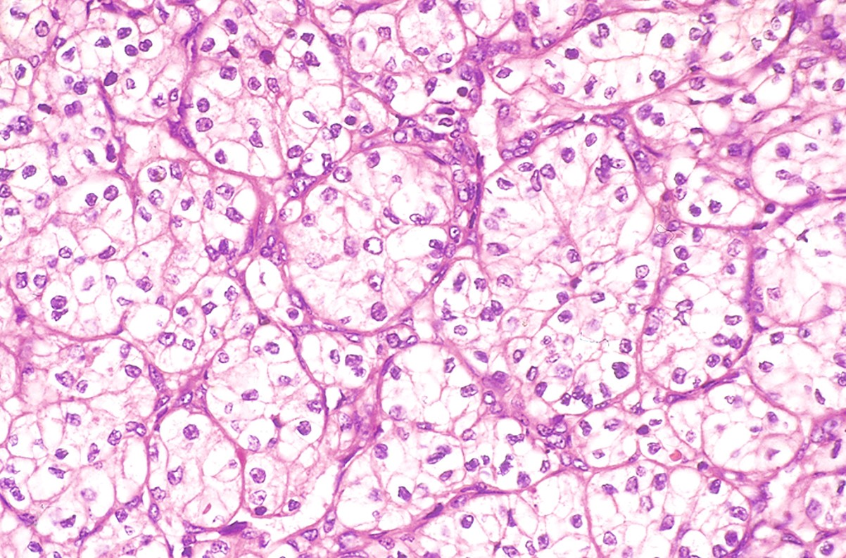 Papillary renal cell carcinoma histopathology showing fibrovascular cores.