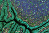 Cancer Biology Cancer Biology